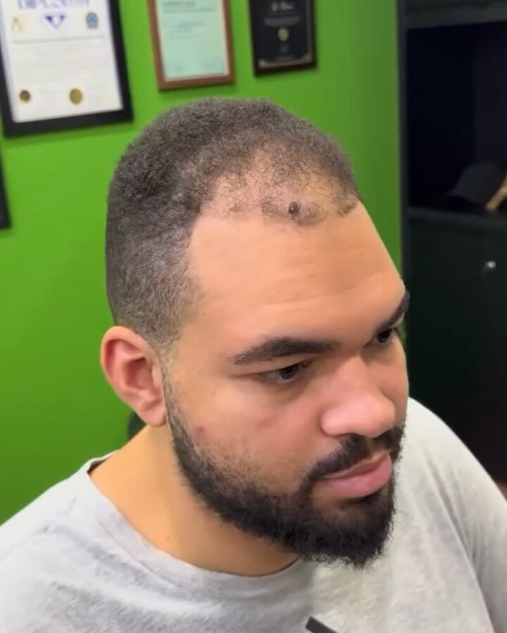 Antes — rarefação capilar