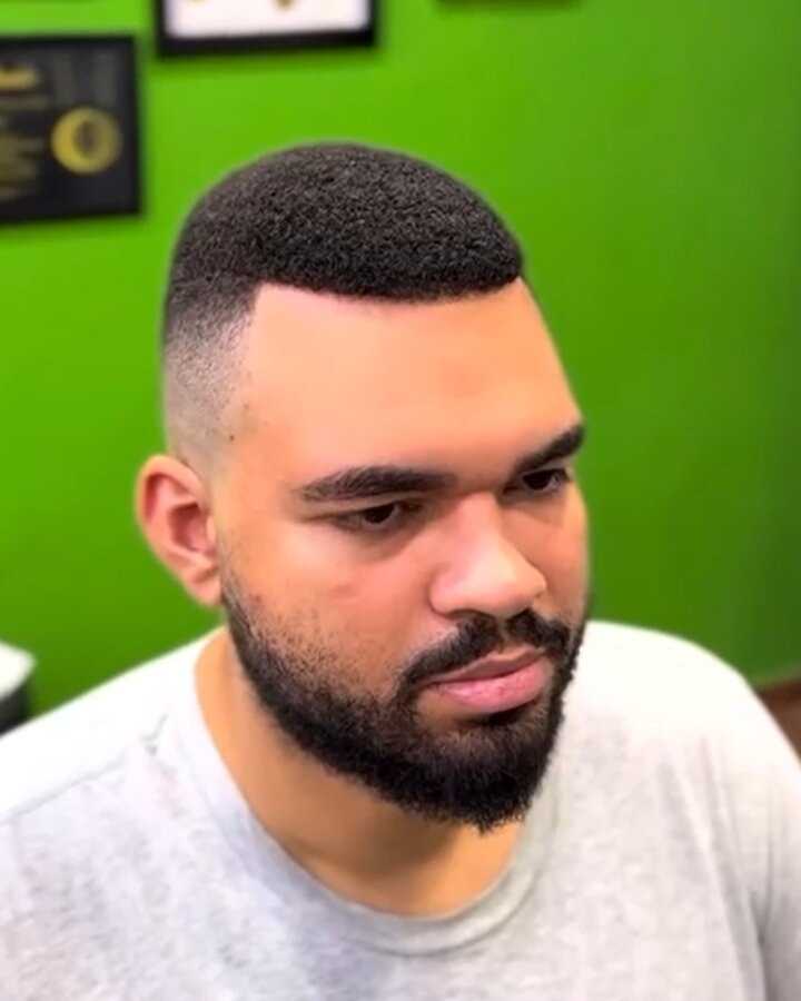 Depois — cabelo natural com prótese