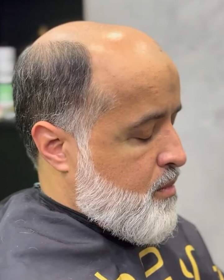 Antes — calvície