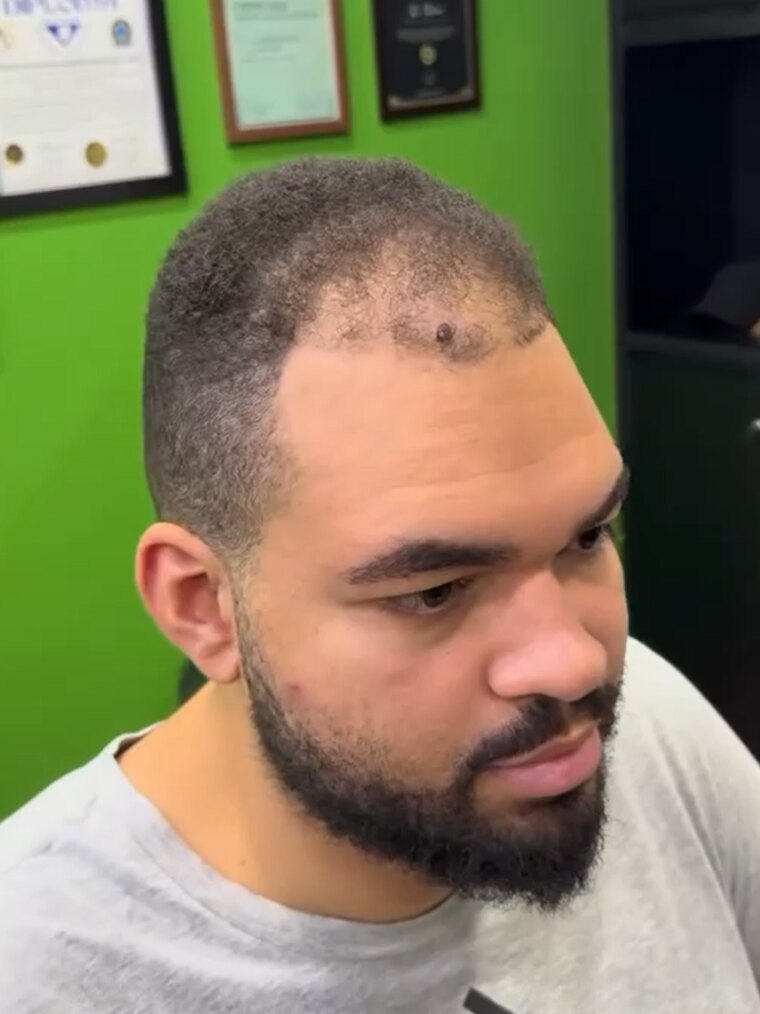 Antes — calvície / rarefação